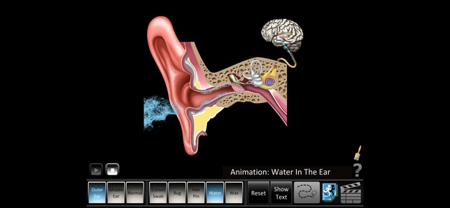 Ear Disorders: Outer Middle(圖3)-速報App