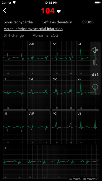 ECG Pro