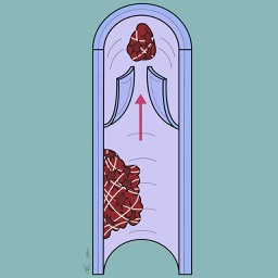 Thromboembolism Risk - "iPad Edition"