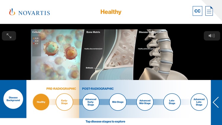 AS Progression Visualizer by Novartis Pharmaceuticals Corporation