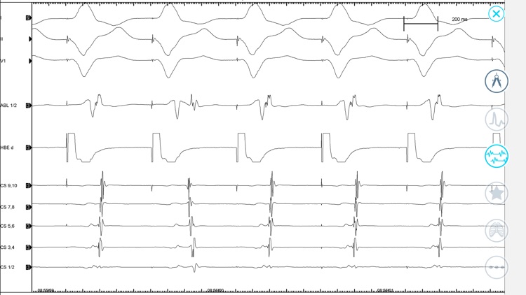 Cardiac Arrhythmia Challenge screenshot-6