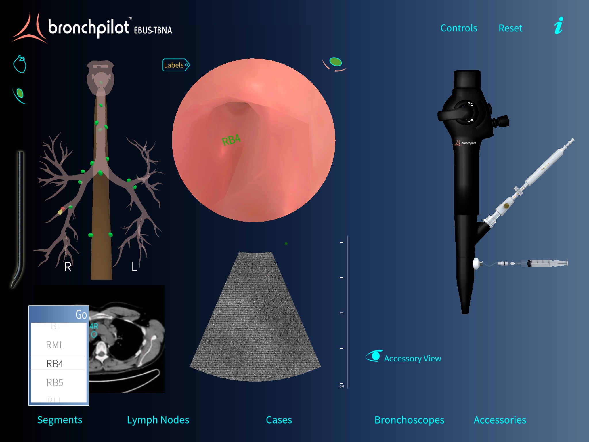 BronchPilot EBUS-TBNA screenshot 4