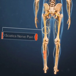 SciaticaRelief
