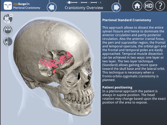 Pterional Craniotomyのおすすめ画像2