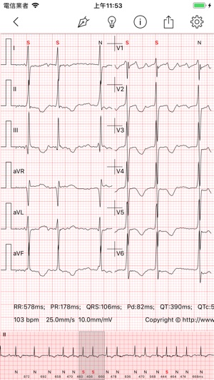 ECG Pro - 海量心電圖案例和診斷詳解(圖4)-速報App