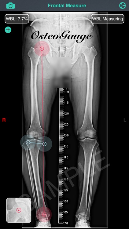 OsteoGauge - lower limb screenshot-3