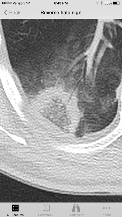 Lung CT Field Guide