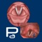The Vocal Pathology: Paresis/Paralysis app helps students and patients learn and professionals teach vocal pathologies