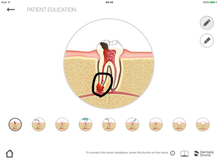 Dentsply Endo IQ® App screenshot-4