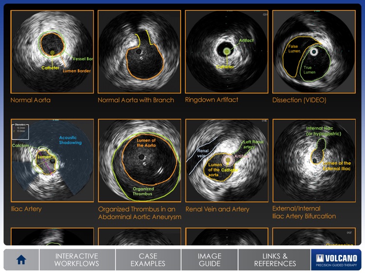 Aortic IVUS screenshot-3