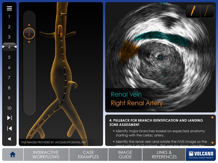 Aortic IVUS