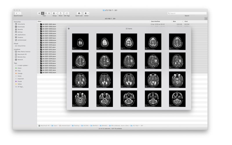 DICOM Quicklook by OsiriX