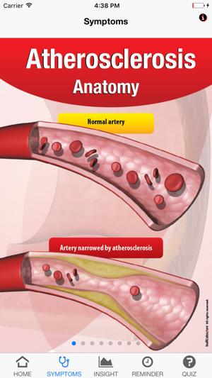 Signs & Symptoms Atherosclerosis(圖2)-速報App