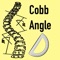 Cobb method is considered the standard for measuring curve size in scoliosis