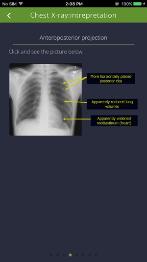 Chest Radiographs(圖3)-速報App