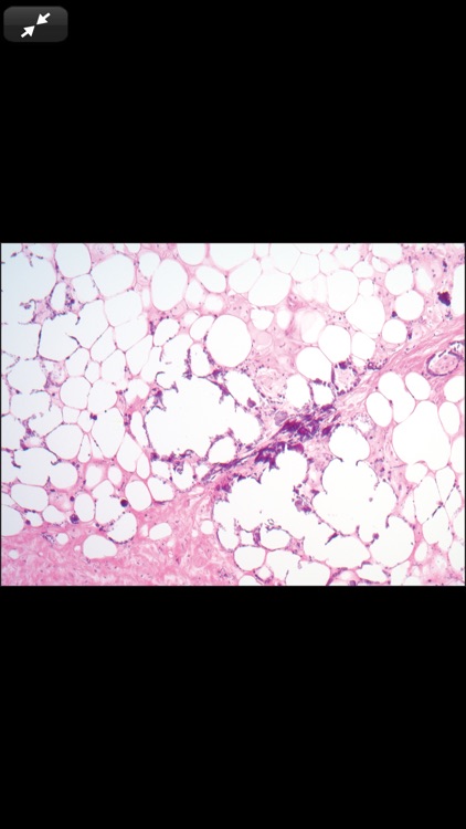 Anatomic Pathology Flashcards screenshot-4