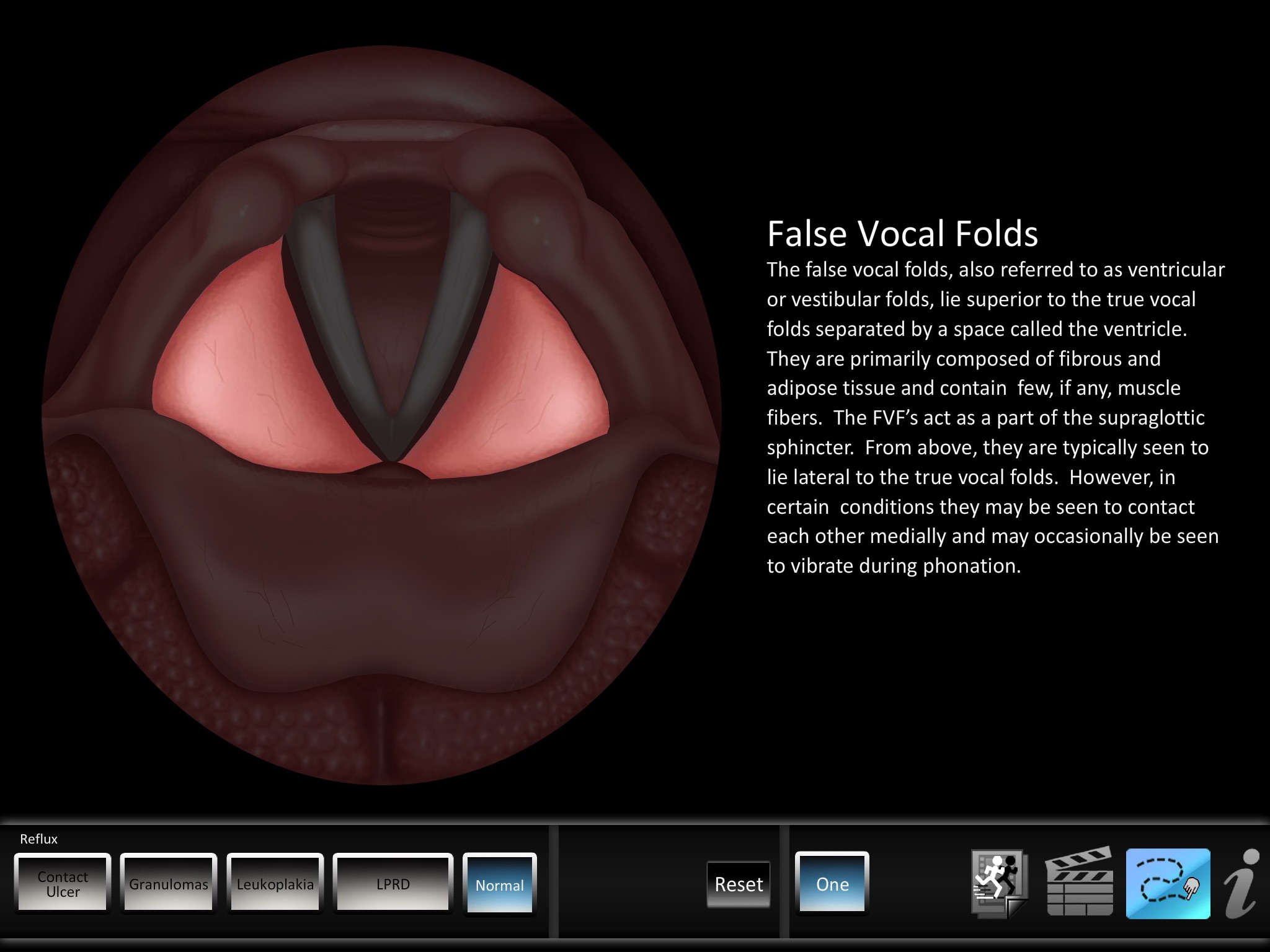 Vocal Pathology: Reflux screenshot 2