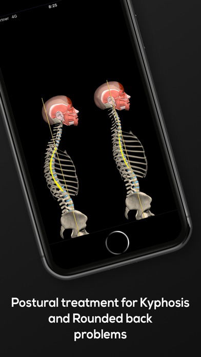 Kyphosis & Rounded Back screenshot 4