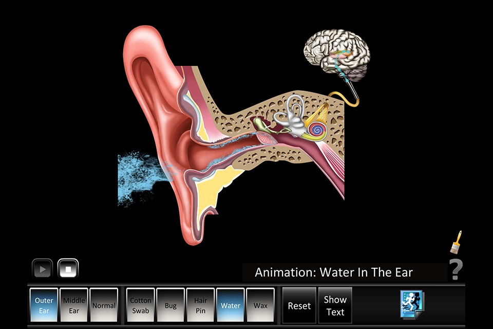 Ear Disorders: Outer Middle screenshot 3