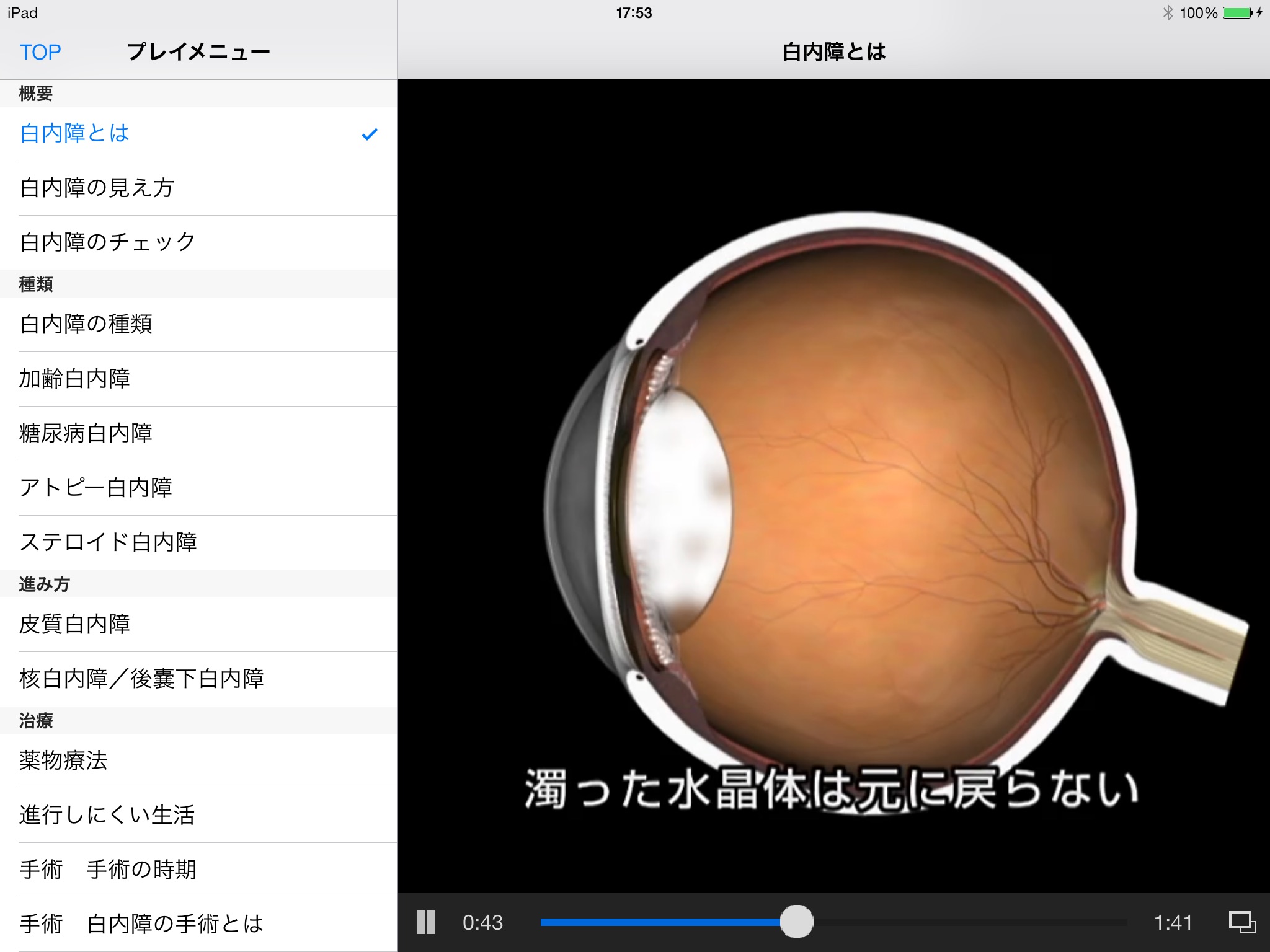 iCeye 白内障 screenshot 2