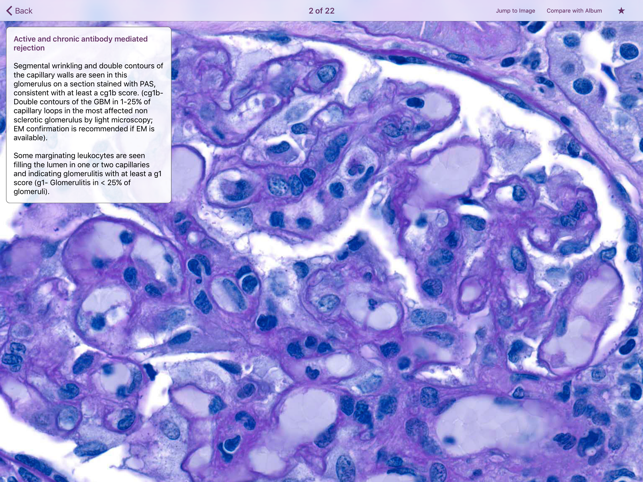 Renal Transplant Pathology(圖3)-速報App