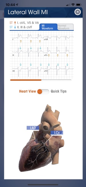 NK 12-Lead ECG Wheel(圖3)-速報App