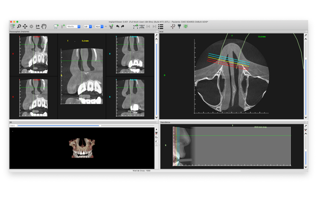 ImplantViewer(圖1)-速報App