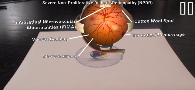 Diabetic Retinopathy AR(圖2)-速報App