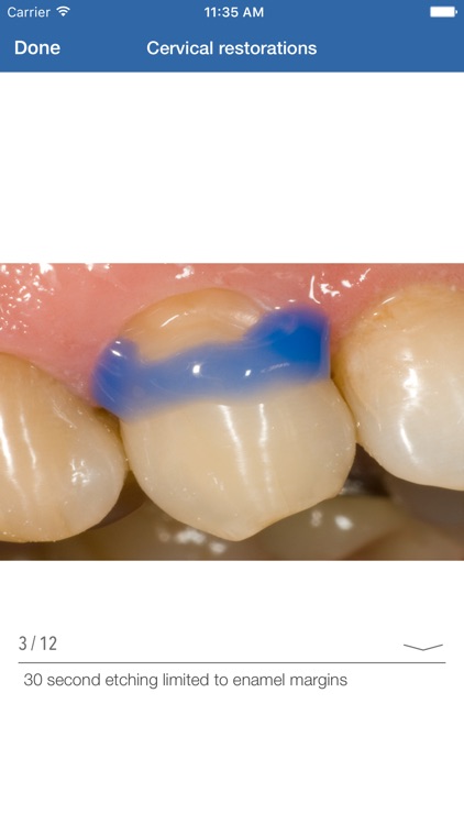 Dental Composite