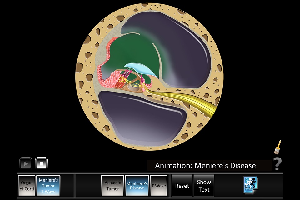 Ear Disorders: Inner screenshot 2