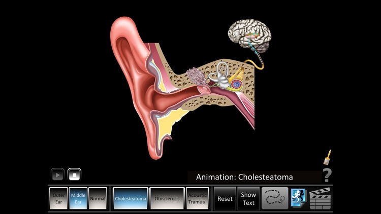 Ear Disorders: Outer Middle screenshot-4