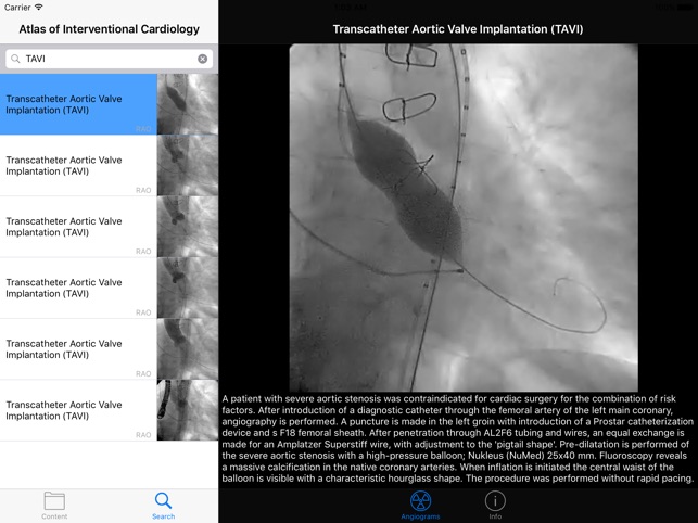 CARDIO3®Invasive Cardiology HD(圖2)-速報App