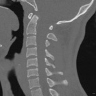 CT Cervical Spine