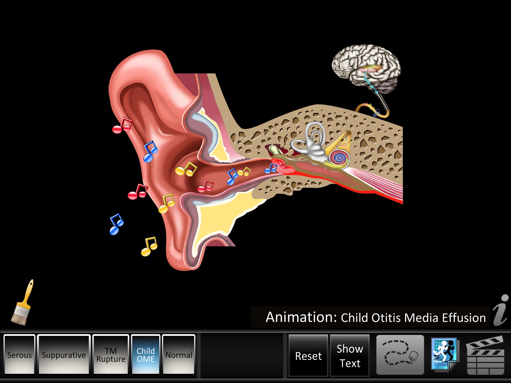 Otitis Media Disorders screenshot 3