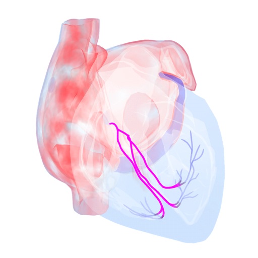 Atrial Fibrillation