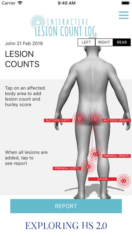 Hs Lesion Counts