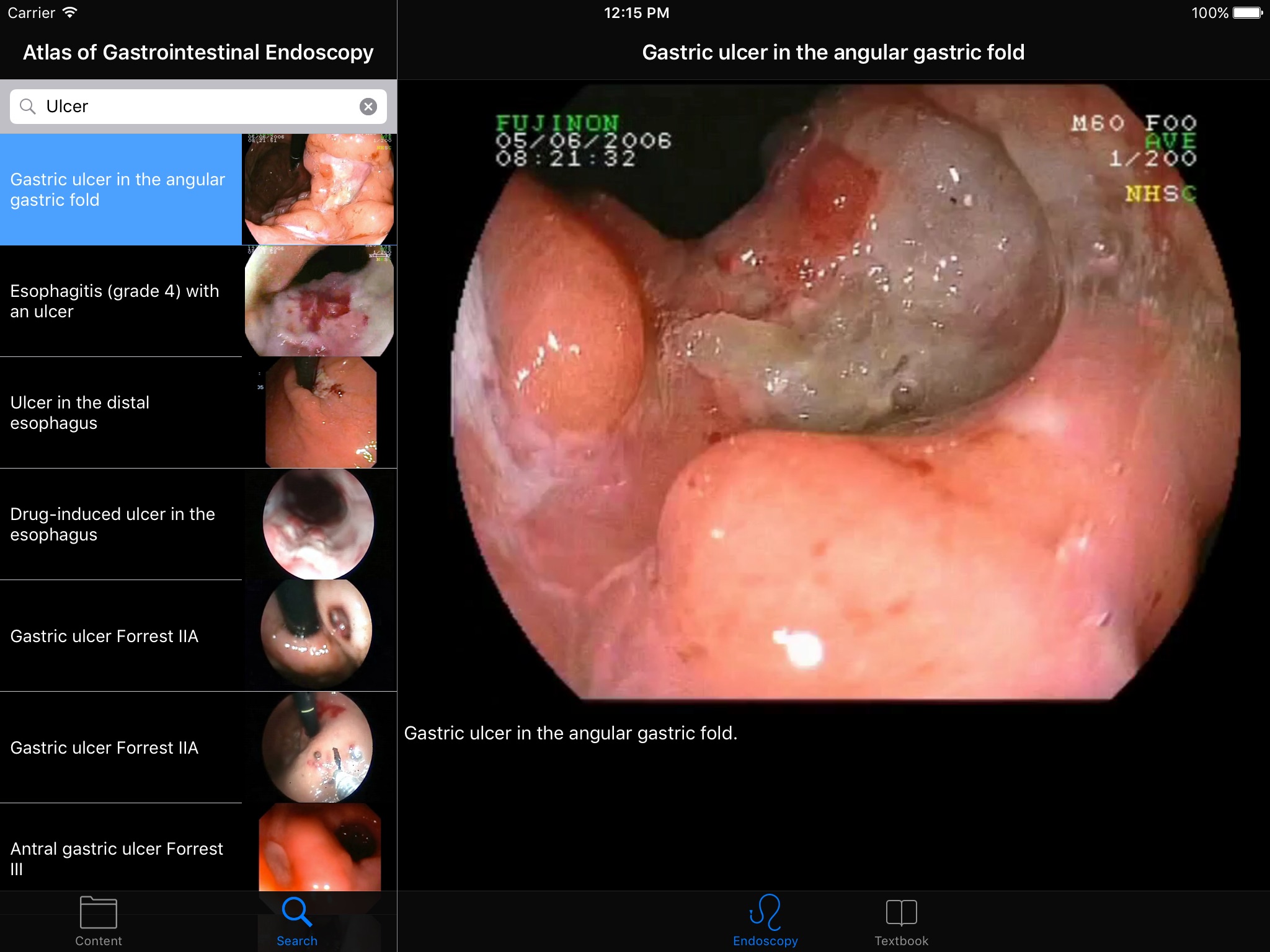 ENDO3®Atlas of GI Endoscopy HD screenshot 2