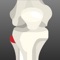 The foot drops down, cannot be lifted up while walking, the toes catch on the ground