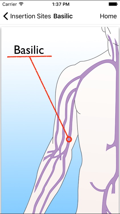 Catheter - patient version