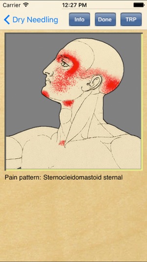 Dry Needling Therapy(圖2)-速報App