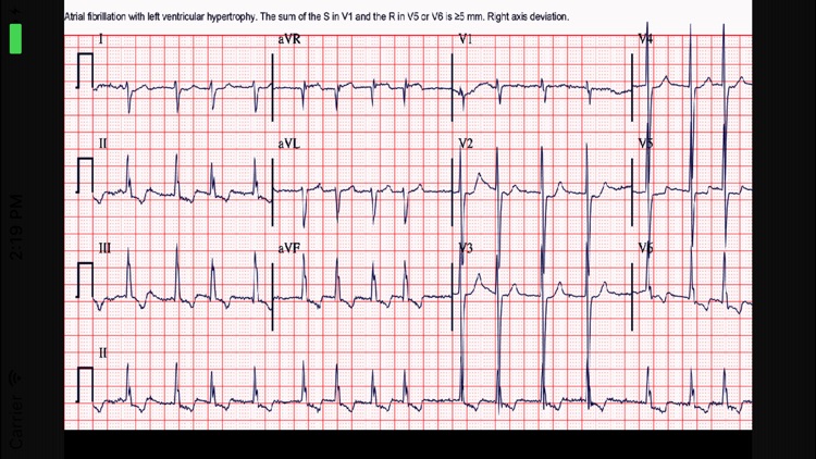 ECG Interpreter screenshot-4