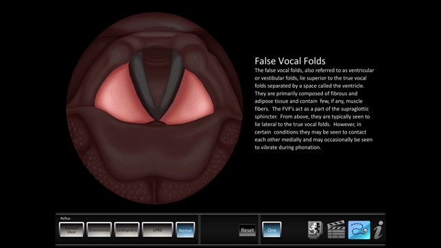 Vocal Pathology: Reflux(圖2)-速報App