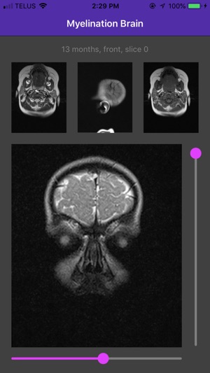 Myelination Brain(圖2)-速報App