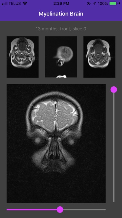 Myelination Brain