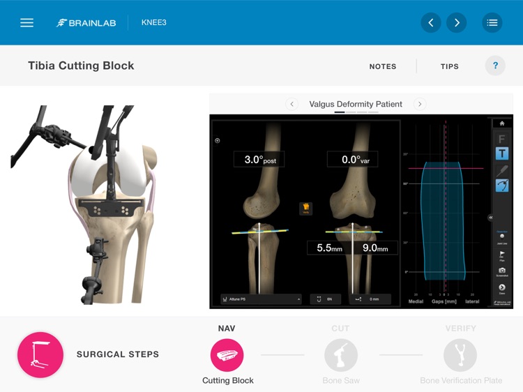 Brainlab KNEE3 screenshot-4