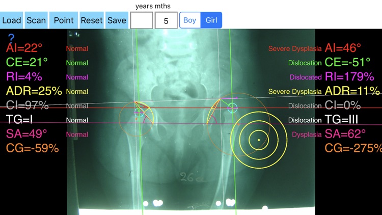 HipDysplasiaApp screenshot-4