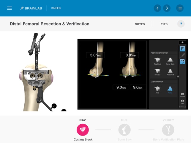 Brainlab KNEE3(圖4)-速報App