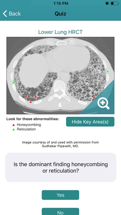 Rad Rounds UIP to IPF screenshot 3