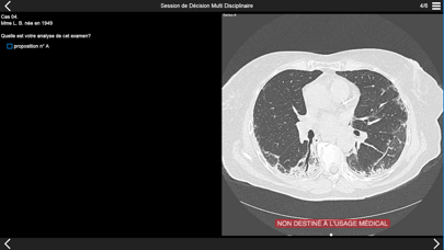 Fibrose pulmonaire 2017 screenshot 2