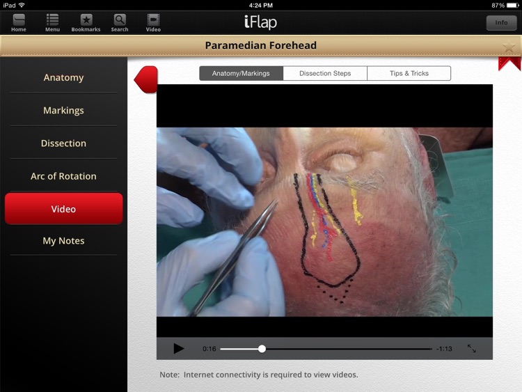 iFlap: Reconstructive Flaps screenshot-3